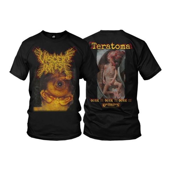 Teratoma